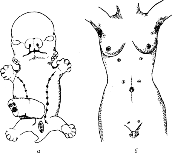 Явление полителии в эмбриональном периоде (а) и его проявление у женщины в зрелом возрасте (б).