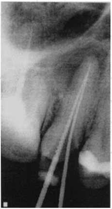 Повторное лечение. Продолжение. Удаление корневой пломбы и рентген-контроль прохождения корневого канала зуба 1.5.
