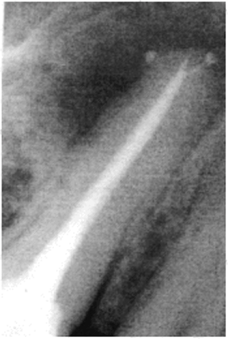 Повторное лечение. Продолжение. Рентген-контроль состояния периапикальных тканей 1.5 зуба через б мес.