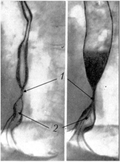 Рентгенограмма пищевода при короткой пептической стриктуре на почве ГПОД. Пищевод укорочен, часть кардиального отдела желудка находится в заднем средостении.