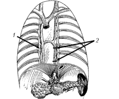 Схема торакоскопической левосторонней спланхникэктомии с иссечением большого чревного нерва на уровне ThX — ТИХI.