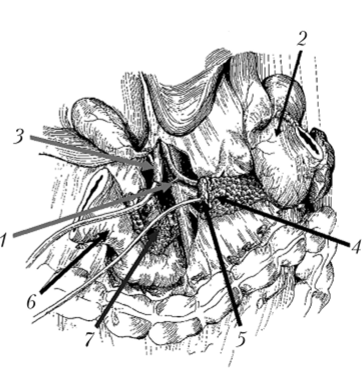 Удаление панкреатодуоденального комплекса. Органокомплекс фиксирован на прошитой сшивающим аппаратом У О (справа от верхней брыжеечной вены) двенадцатиперстной кишке и крючковидном отростке.