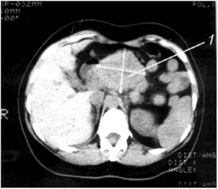 Компьютерная томография. Рак тела поджелудочной железы.