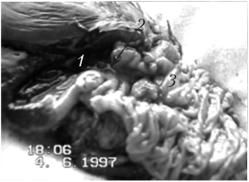 Макропрепарат после панкреатодуоденальной резекции, выполненной той же больной, снимок которой показан на рис. 21.8.