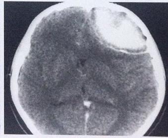 Эпидуральная гематома в лобной области слева. На КТ после контрастного усиления определяется участок высокой плотности, окруженный зоной перифокального контрастирования (формирующаяся капсула).