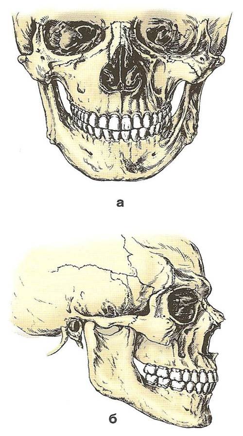Рис. 2. Положение зубных рядов в центральной окклюзии: а — вид спереди; б — вид сбоку При ортогнатии (ortos — прямой, gnatio — челюсть) имеется небольшое перекрытие резцами верхней челюсти зубов нижней челюсти. Прогения (pro — вперед, genio — подбородок) характеризуется обратными отношениями. Для бипрогнатии типичен наклон вперед верхних и нижних зубов с перекрытием нижних верхними. В прямом прикусе режущие края верхних и нижних резцов соприкасаются друг с другом (рис. 3).
